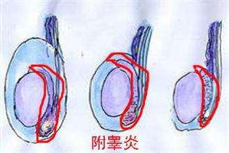 兰州男性附睾炎的症状表现有哪些