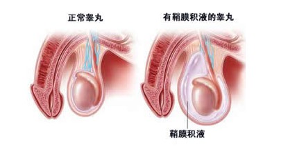 鞘膜积液是怎么回事?